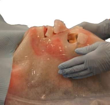 BurnTec Facemask Hydrogel Dressing 30 x 40 cm